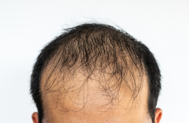 hair transplant sheffield