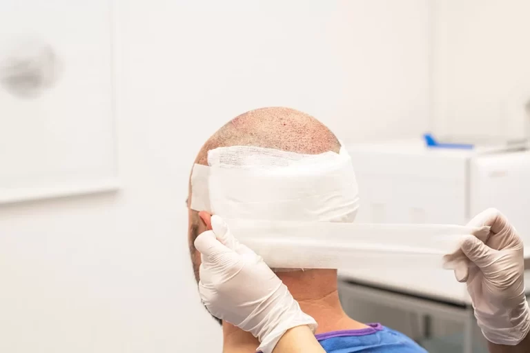 hair transplant bandage removal guide