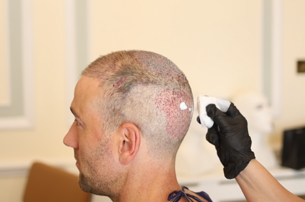 aftercare hair transplant