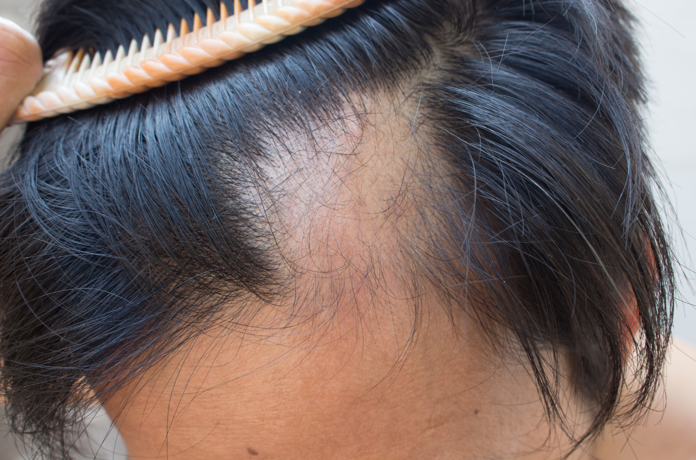 hair loss thinning hair