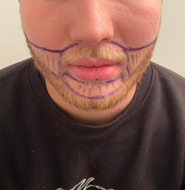 beard line drawing before hair transplant