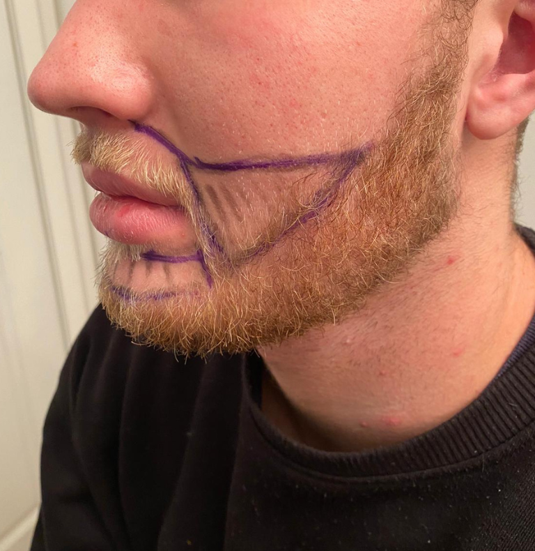 beard transplant side view drawing