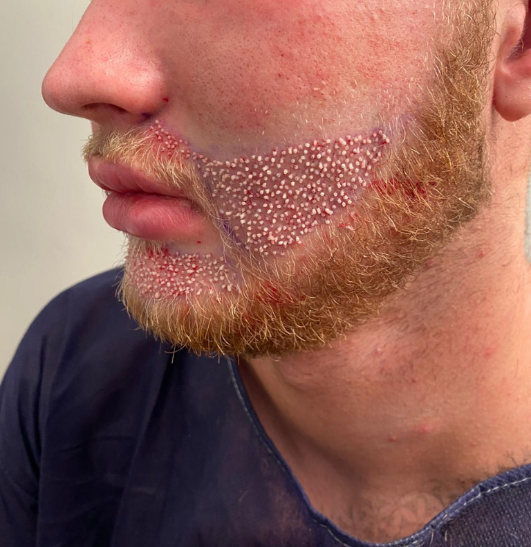 beard grafts implantation