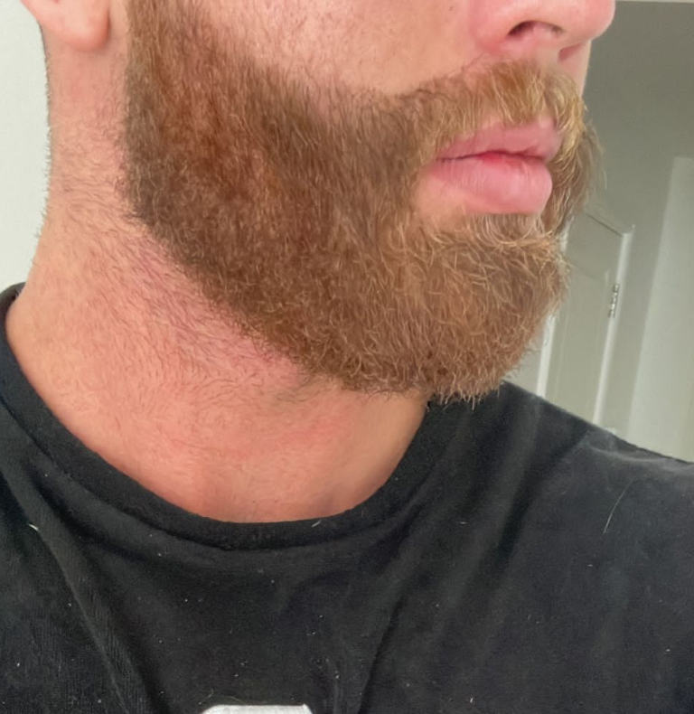 beard transplant after results